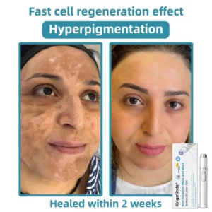 Ringminds® Non-invasive Mole & Wart Removal Laser Pen(Quick and painless removal of warts, moles, age spots, and skin tags with no side effects)