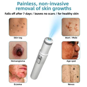 Ringminds® Non-invasive Mole & Wart Removal Laser Pen(Quick and painless removal of warts, moles, age spots, and skin tags with no side effects)